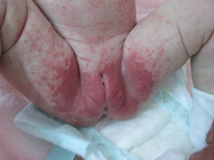 Diaper dermatitis—a narrative review of clinical presentation, subtypes,  and treatment