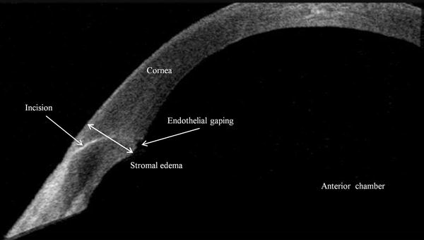 Early changes in corneal edema following torsional phacoemulsification  using anterior segment optical coherence tomography and Scheimpflug  photography | Japanese Journal of Ophthalmology