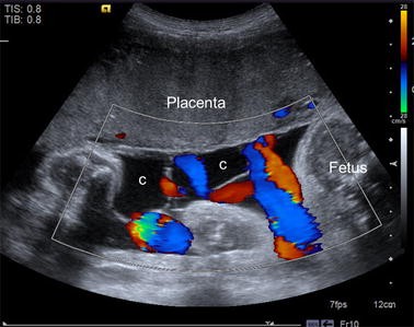 Velamentous Cord Insertion: Precautions, Outcomes & Risks