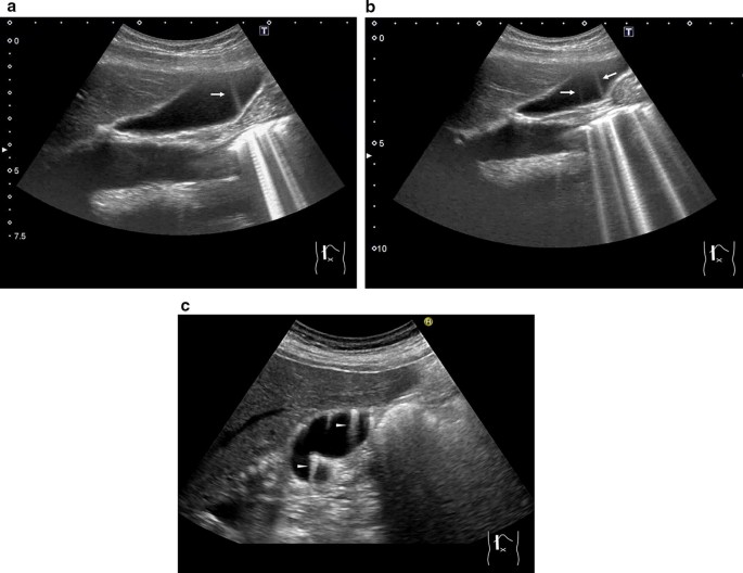 Value of contrast-enhanced ultrasound in the differential diagnosis of  ureteral tuberculosis from ureteral malignant tumour in w