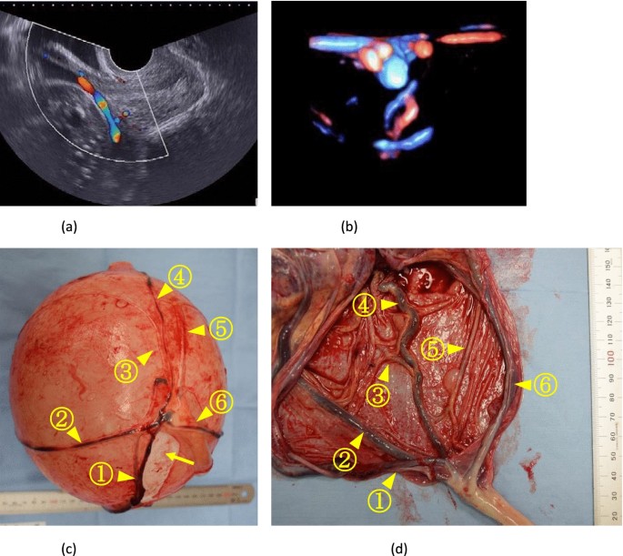 Extreme caution needed during cesarean section due to complicated fetal  membrane vascular course in vasa previa without accessory or low-lying  placenta | Journal of Medical Ultrasonics