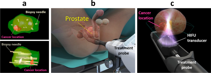 Treatment of Post, High-Intensity-Focused Ultrasound Urethral