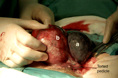 Ovarian conservation in adnexal torsion-a report of six cases, Gynecological Surgery