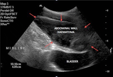 Ovarian Cysts - Philippe de Rosnay