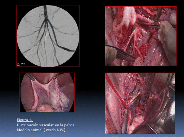 Laparoscopic Non-Mesh Cerclage Pectopexy for Pelvic Organ Prolapse