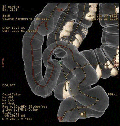 AUBMC - American University of Beirut Medical Center - Dysmenorrhea, or menstrual  cramps, is the pain felt by a woman for one to three days before her period.  Pain is the outcome