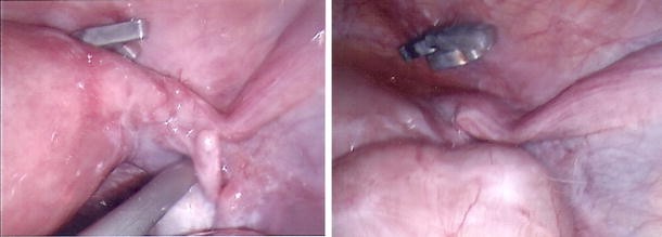 Tubal ectopic pregnancy on a patient with two previous consecutive  laparoscopic tubal sterilisation techniques | Gynecological Surgery | Full  Text