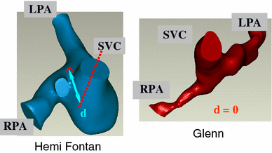 Hemodynamic Performance of Stage-2 Univentricular Reconstruction: Glenn vs.  Hemi-Fontan Templates | Annals of Biomedical Engineering