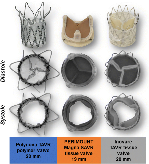 perimount aortic valve replacement