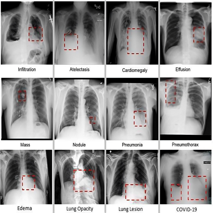 AI Analysis Can Improve Lung Cancer Detection on Chest Radiographs