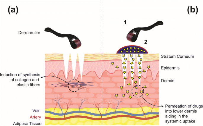 Derma rollers in therapy: the transition from cosmetics to transdermal drug  delivery | Biomedical Microdevices
