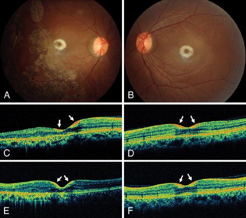 Diagnostic and predictive methods for a Niemann-Pick disease type