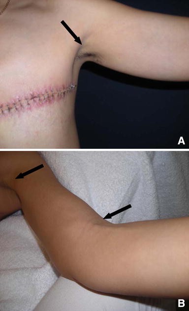 The Lymph Clinic - Axillary Web Syndrome or Cording. What is it