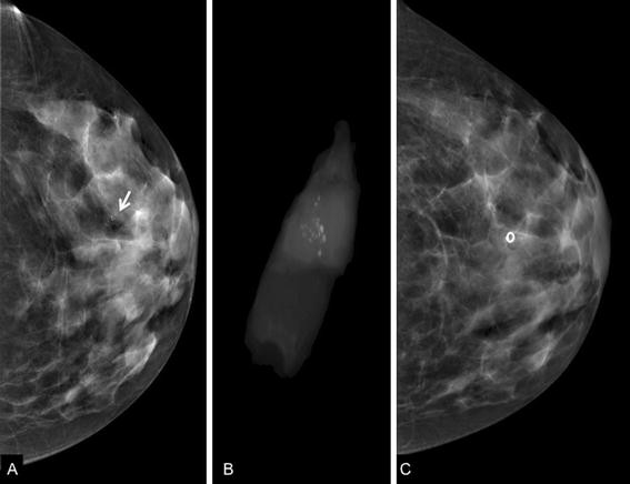 A plea for the biopsy marker: how, why and why not clipping after breast  biopsy?