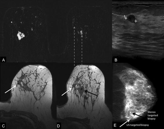 Metallic Marker Placement After Stereotactic Core Biopsy of Breast  Calcifications: Comparison of Two Clips and Deployment Techniques