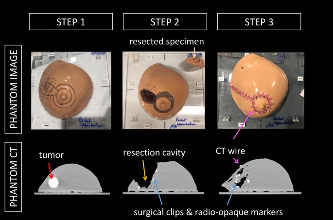 Can we rely on surgical clips placed during oncoplastic breast surgery to  accurately delineate the tumor bed for targeted breast radiotherapy?