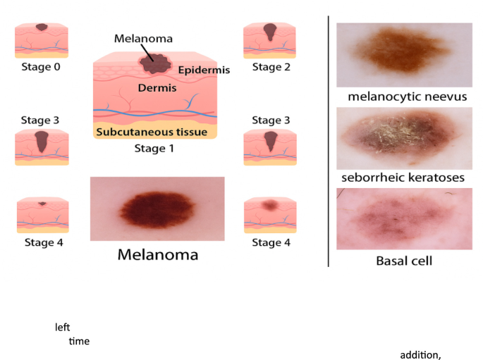 melenic vs melanotic stool Dark stool vs black stool — the difference can be serious. Dark brown stool  is often food or iron-related. Black, tarry stool may indicate internal  bleeding and needs urgent medical attention. 👨‍⚕️