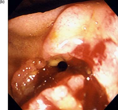 Periampullary Choledochoduodenal Fistula Associated with Ampulla of Vater  Carcinoma | Digestive Diseases and Sciences
