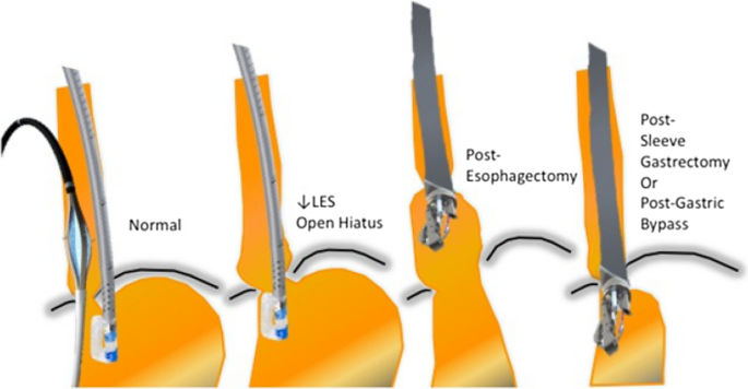 Endoscopic Management of GERD  Digestive Diseases and Sciences