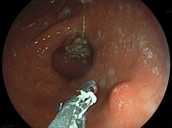 glp 1 reflux Walker Street Doctors | GLP-1s can be incredibly effective - but they're a tool, not a shortcut. They quiet appetite. What matters is what you build in that Gastrointestinal effects of GLP-1 receptor