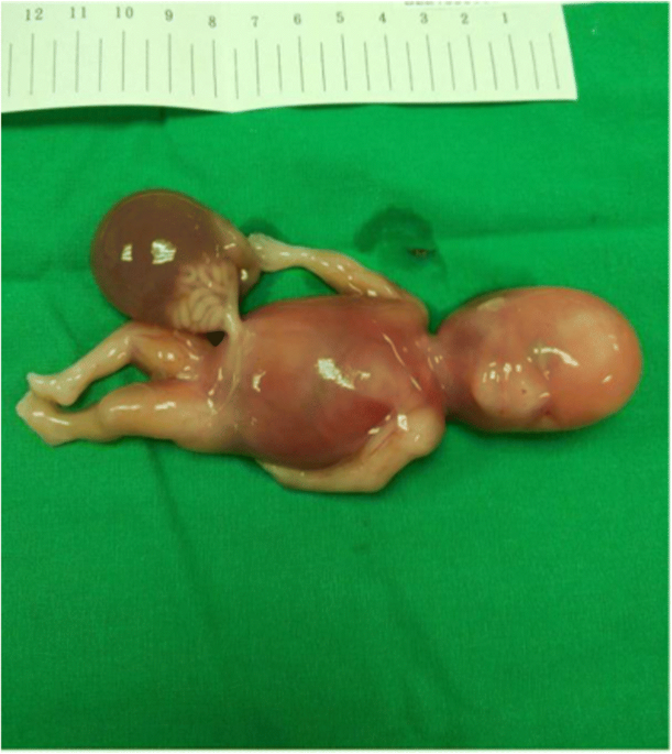 Live euploid birth and complete hydatid mole, followed by partial hydatid  mole after ICSI | Journal of Assisted Reproduction and Genetics