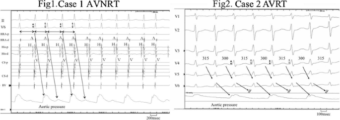 FV provides tilt table testing to safely and effectively diagnose syncope  due to Cardiovascular disease - FV Hospital