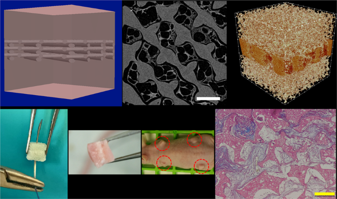 Silk fibroin scaffolds for common cartilage injuries