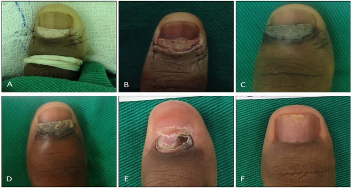 Ingrown Toenails Surgery & Pain Treatment | Ingrown Nail Infection
