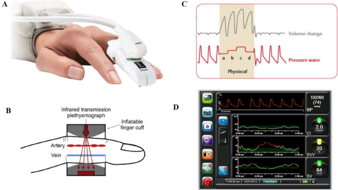 Hemodynamic Instability Spotted Sooner With Continuous Noninvasive BP  Monitors