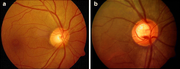 Automated Diagnosis of Glaucoma Using Digital Fundus Images | Journal of  Medical Systems