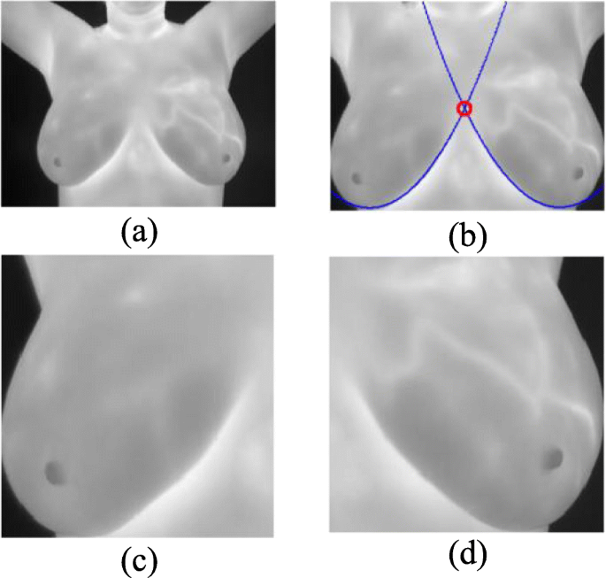 Analysis of Breast Thermograms Using Asymmetry in Infra-Mammary Curves