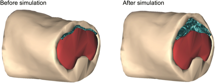 Insufflated Laparoscopic Model - PulseMDM