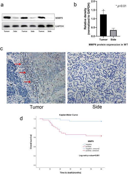 Role of MMP-9 in epithelial-mesenchymal transition of thyroid cancer, World Journal of Surgical Oncology