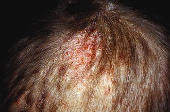Tinea Capitis: Ringworm Hair Loss - Erdem Clinic