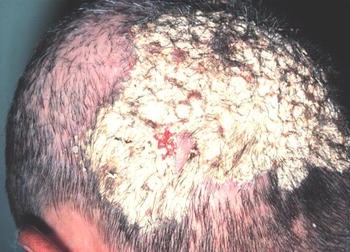 Tinea Capitis: Ringworm Hair Loss - Erdem Clinic