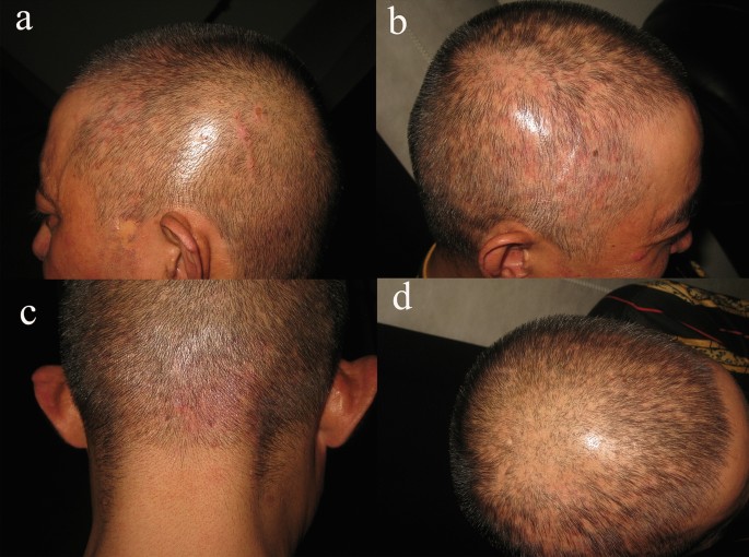 Tinea Capitis in 31 Year Old Adult Male: A Rare Entity