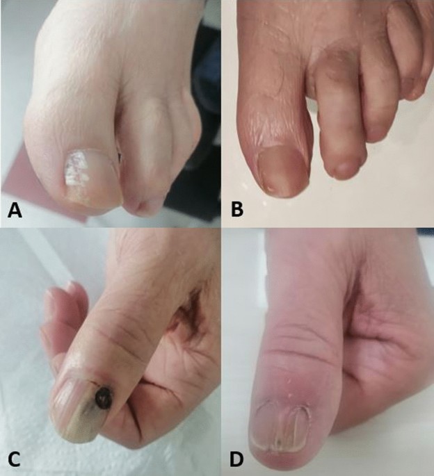 Onychomycosis | Treatment & Management | Point of Care