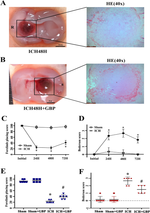 gabapentin and glutathione Gabapentin Alleviates Brain Injury in Intracerebral Hemorrhage Through  Suppressing Neuroinflammation and Apoptosis | Neurochemical Research