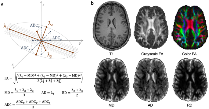 Diffusion Tensor Imaging in Traumatic Brain Injury