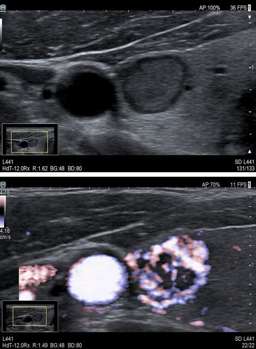 Thyroid ultrasound and its ancillary techniques