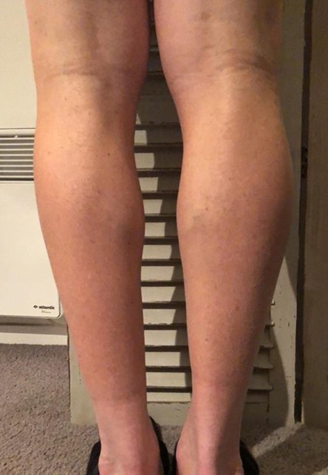 Deep vein thrombosis in a well-trained masters cyclist, is popliteal vein  entrapment syndrome to blame? | Journal of Thrombosis and Thrombolysis