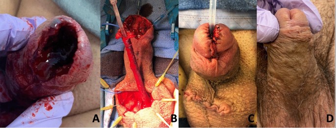 Oncologic control and predictors of urologic reconstruction after Mohs micrographic surgery for low-risk penile malignancy