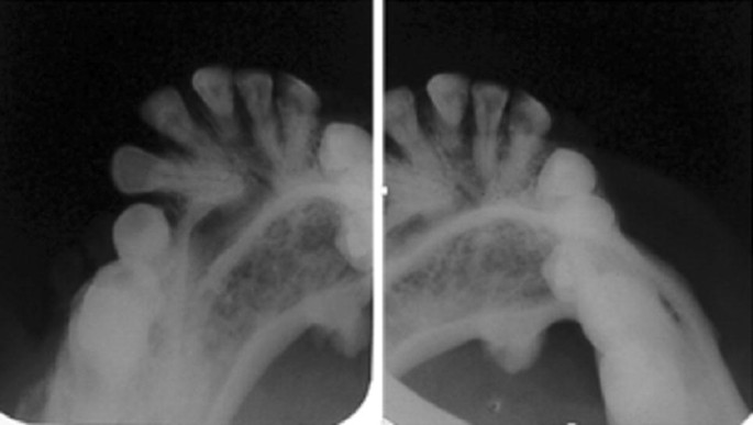 Maxillofacial manifestations of Proteus syndrome: a systematic review with  a case report | Oral Radiology