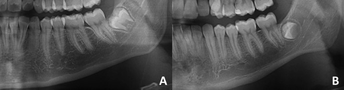 Vitamin D deficiency indicated by pulp tooth shape (X ray)– Nov