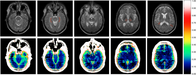 Changes in hippocampal volume during a preceding 10-year period do not correlate with cognitive performance and hippocampal blood‒brain barrier permeability in cognitively normal late-middle-aged men