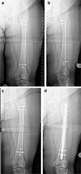 Maintenance of a cement spacer as definitive treatment of post traumatic  osteomyelitis, a case report. | Published in Journal of Orthopaedic  Experience & Innovation
