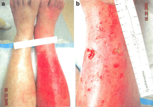 alpha l carnitine crps Treatment of Complex Regional Pain Syndrome (CRPS) Using Low Dose  Naltrexone (LDN) | Journal of Neuroimmune Pharmacology