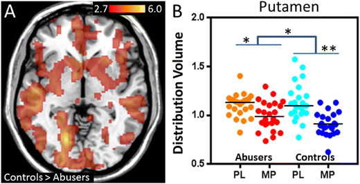 Cannabis Concentrates and Their (Scary) Effect on the Teenage Brain