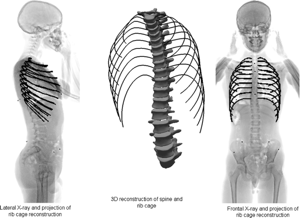 PDF) Rib Cage Measurement Reproducibility Using 3D Stereoradiographic  Reconstruction in Preoperative Adolescent Idiopathic Scoliosis
