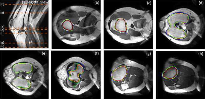 Automated segmentation of trabecular and cortical bone from proton density  weighted MRI of the knee | Medical & Biological Engineering & Computing